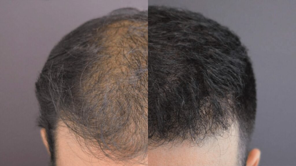 Calvície
Queda de cabelo