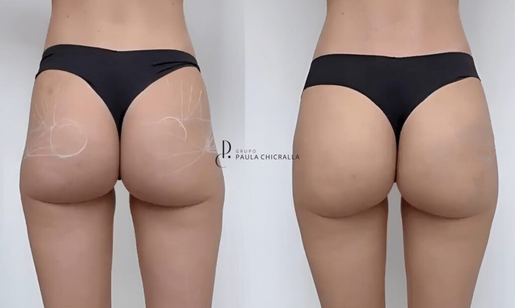 Como empinar os glúteos com segurança e sofisticação: o que realmente funciona? | Grupo Paula Chicralla empinar os glúteos