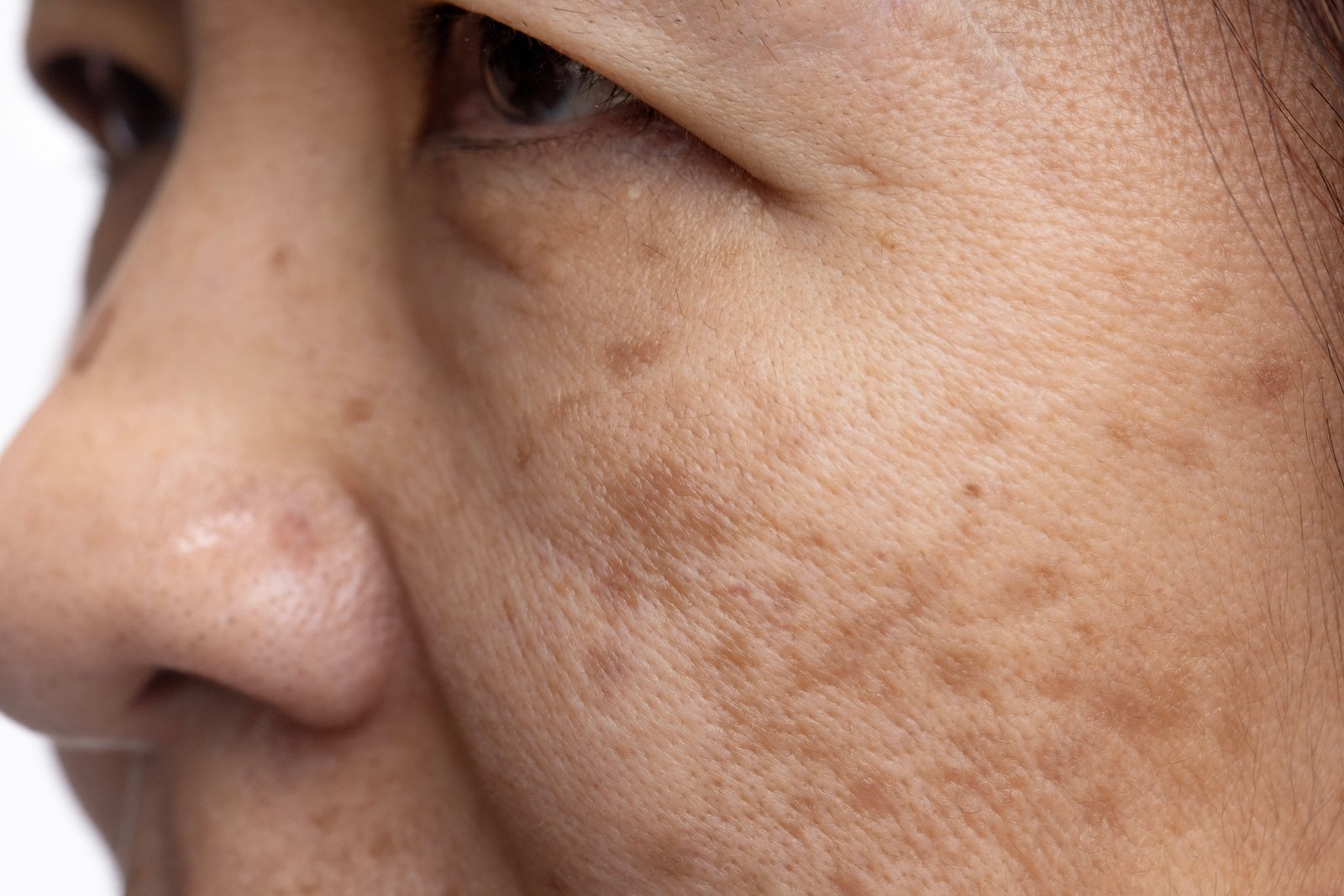 melasma botox