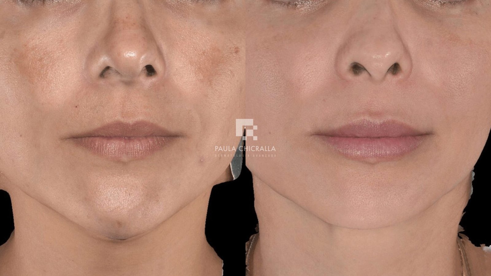 Tratamento para Melasma à Laser: Novidades na Dermatologia Estética | Grupo Paula Chicralla Frame 45412 min