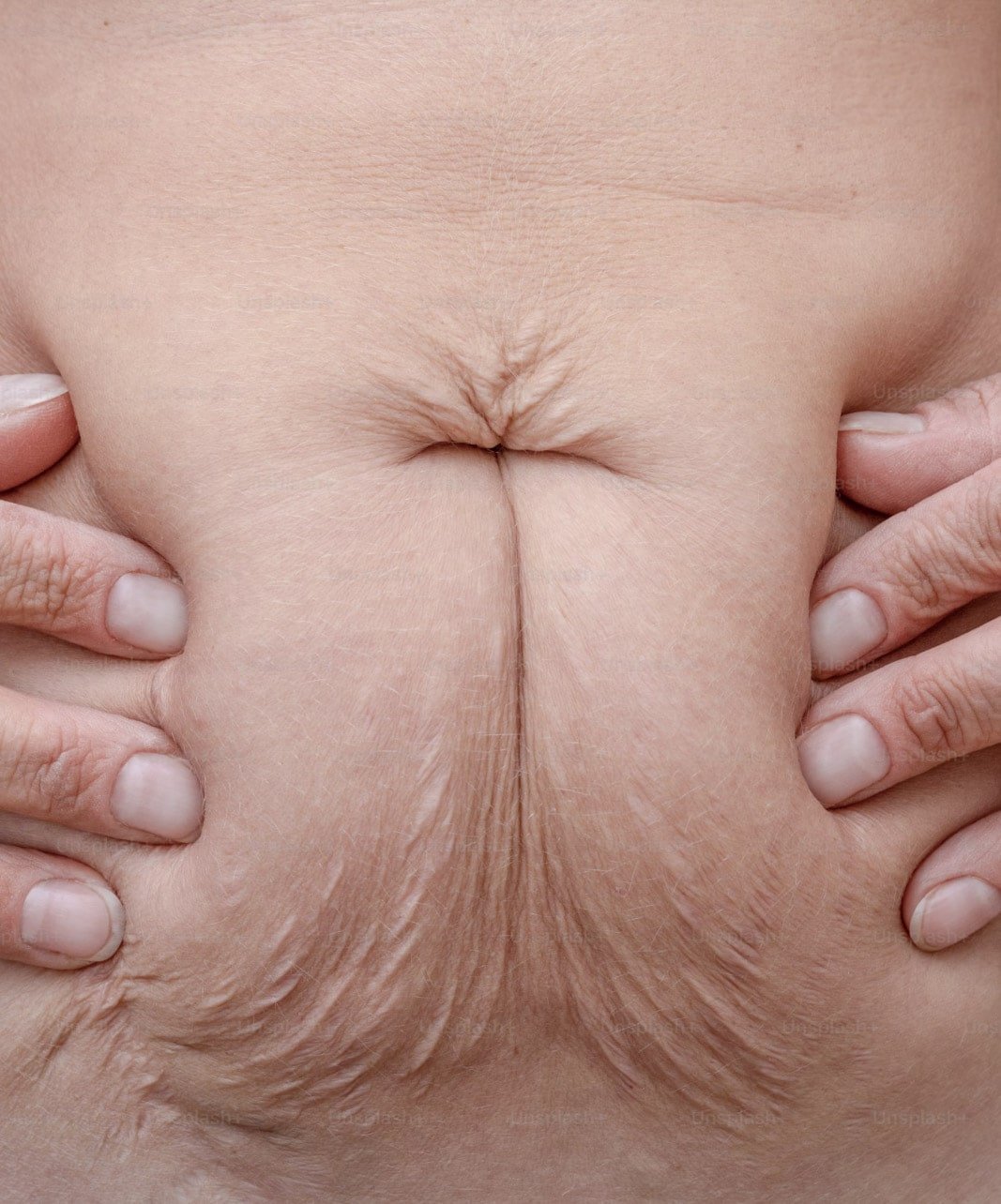 Di&aacute;stase Abdominal